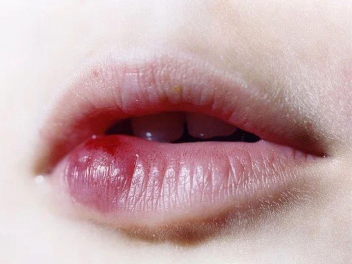 Dấu hiệu bị dị ứng son nguy hiểm