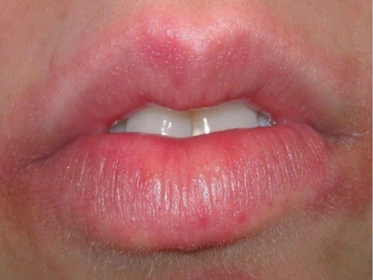 Cảnh báo dị ứng son cực kỳ nguy hiểm