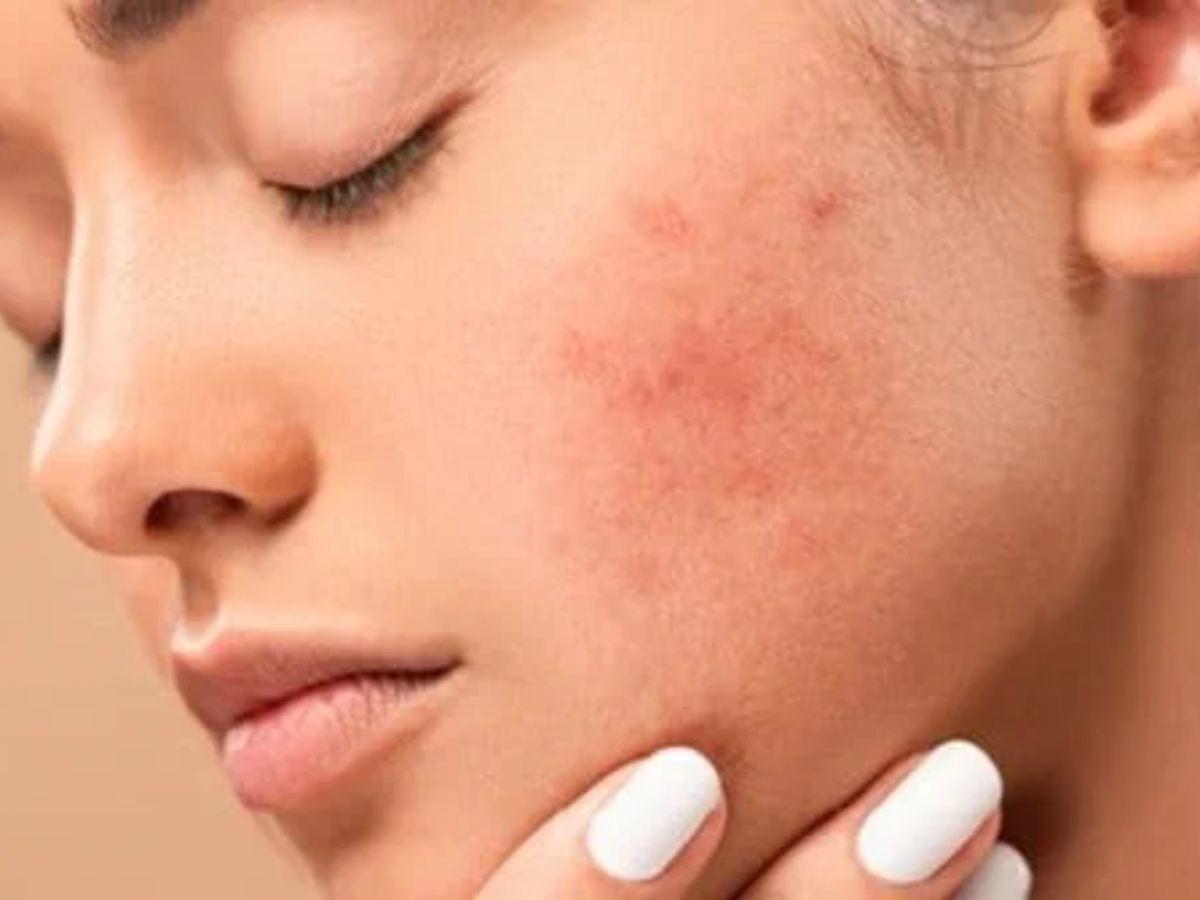 phấn rôm được thiết kế với mục đích chính là hút ẩm cho da em bé