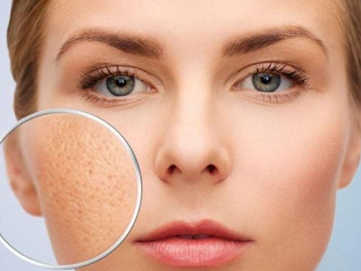 Không tẩy trang khiến lỗ chân lông bít tắc
