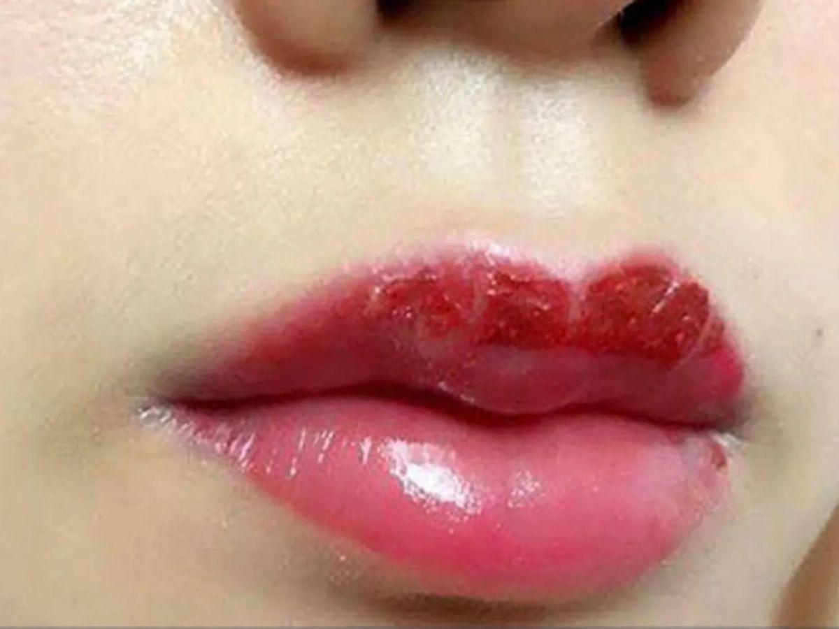 Môi khô, bong tróc, mất nhiều thời gian để môi phục hồi sau phun