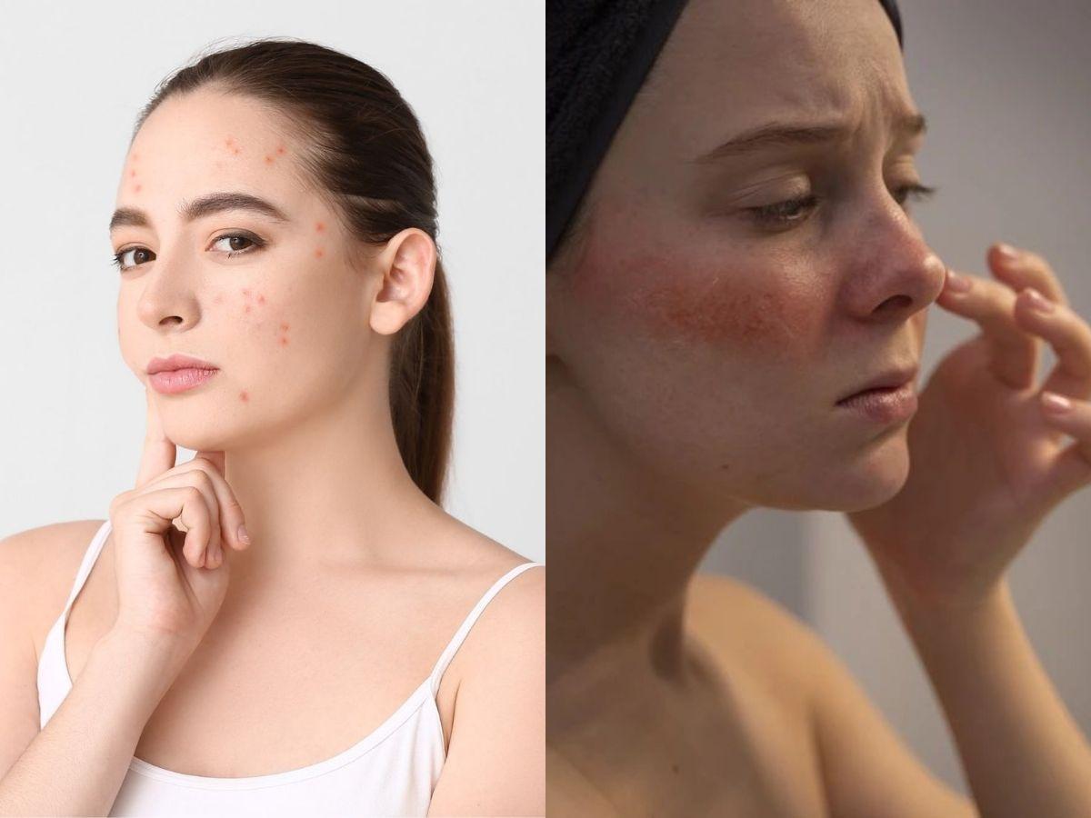 Cách phân biệt đẩy mụn và kích ứng