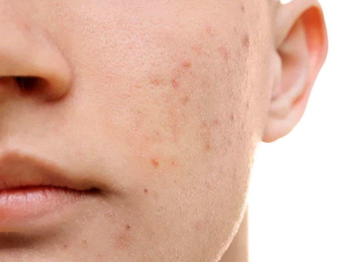 Việc xác định đúng loại da và tình trạng mụn sẽ giúp bạn chọn được serum phù hợp