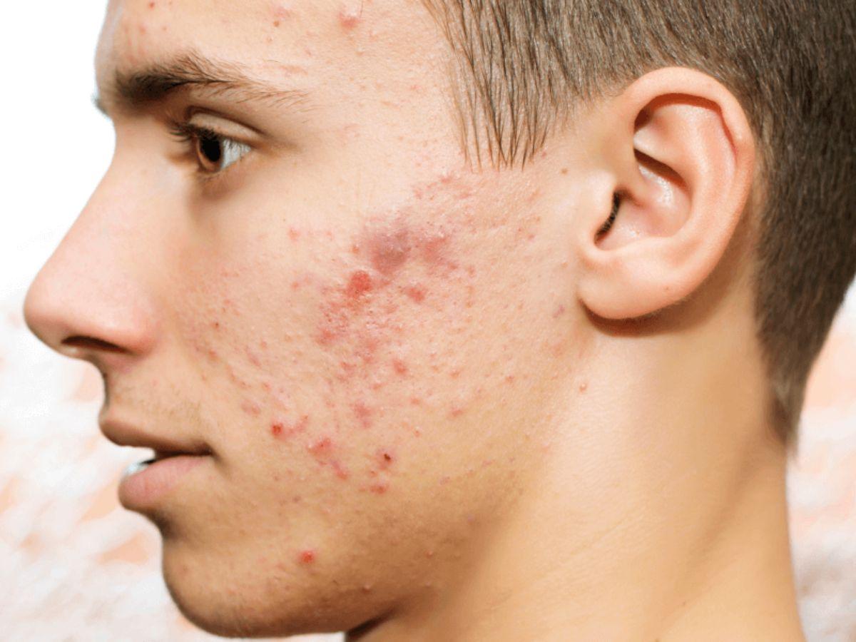 Da nam thường tiết nhiều dầu và dễ nổi mụn do nội tiết và thói quen cạo râu