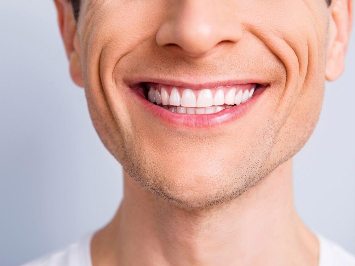 Nếp nhăn khóe miệng không hề phân biệt giới tính