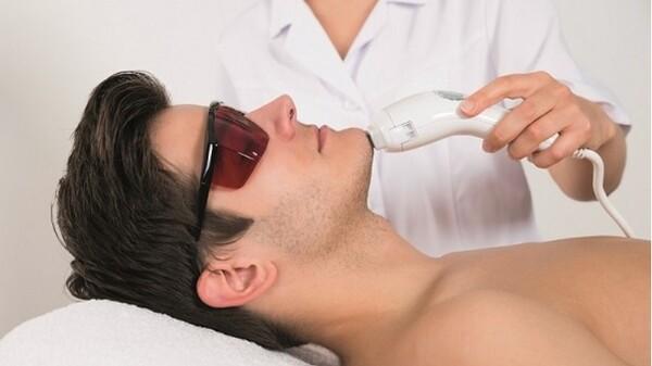 Tẩy lông mặt cho nam bằng công nghệ laser