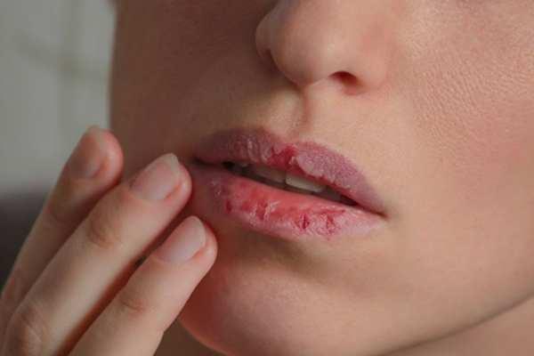môi khô nứt nẻ do thiếu nước
