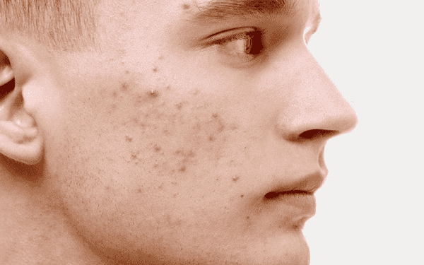 Chăm sóc da không đúng cách khiến da dễ bị dầu nhờn hơn