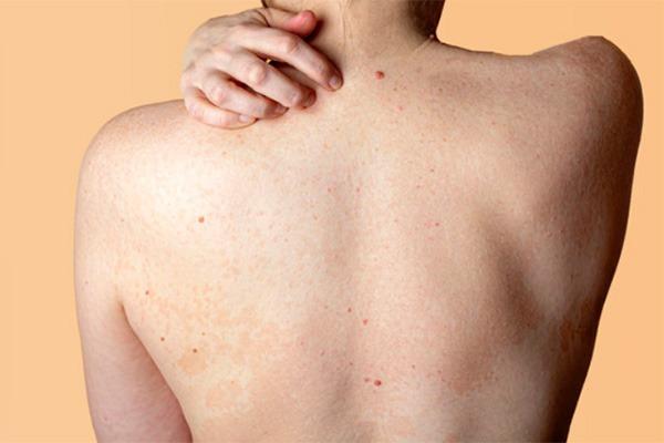 Nguyên nhân gây mụn lưng ở nam giới: yếu tố di truyền