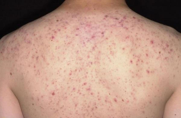 Phương pháp điều trị mụn lưng nam hiệu quả