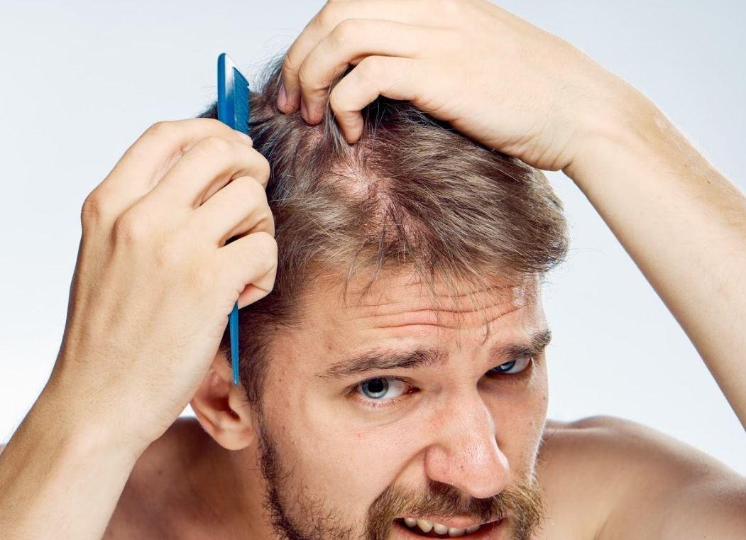 Rụng tóc ở nam giới có thể do di truyền